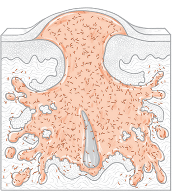 黄ニキビ・嚢腫