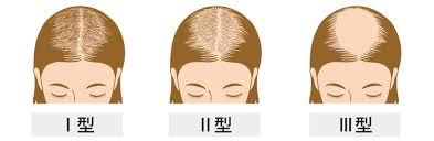女性型脱毛症