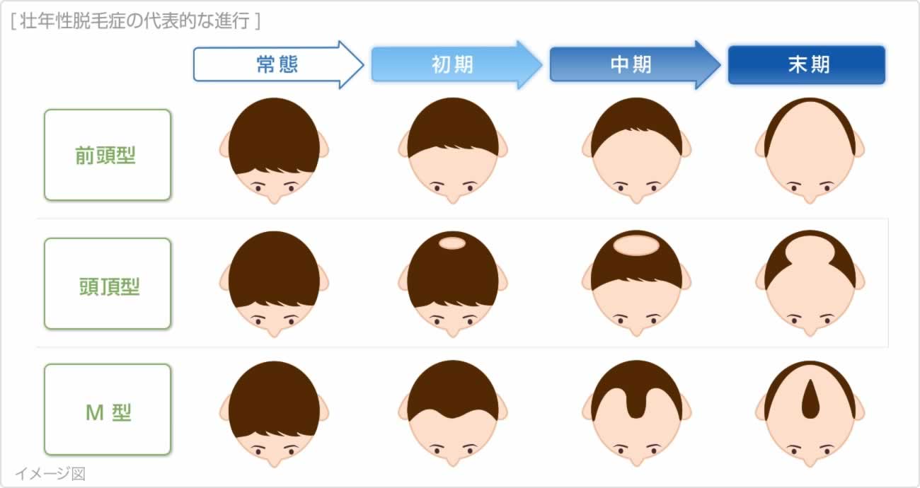 男性型脱毛症